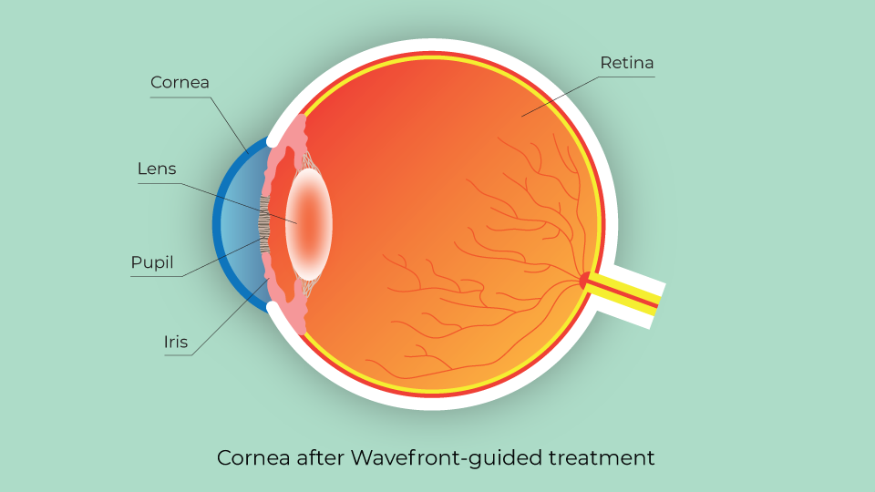 Cornea after wavefront guided treatment