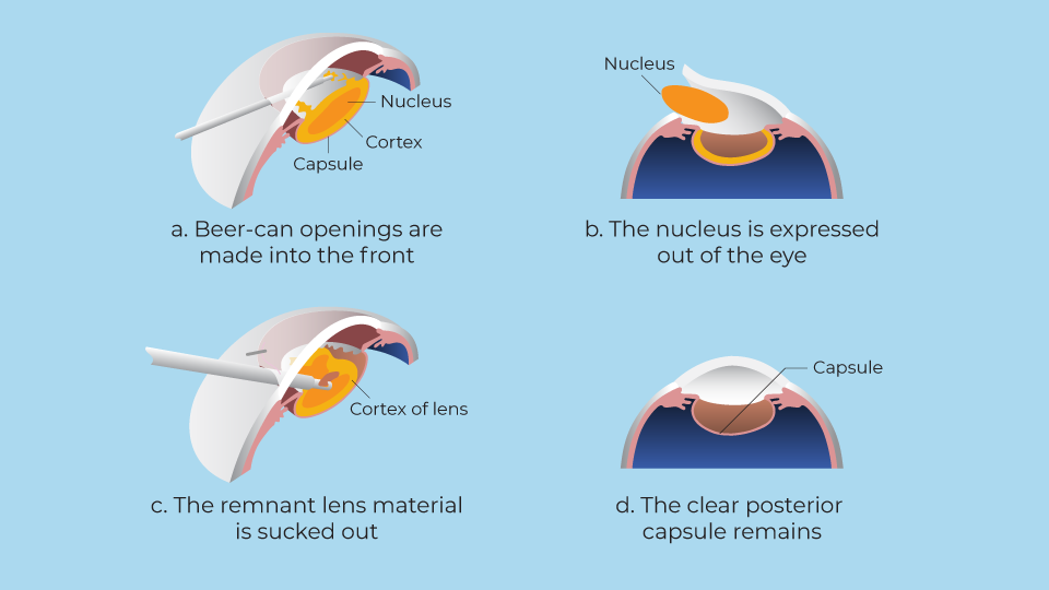 Extracapsular cataract surgery