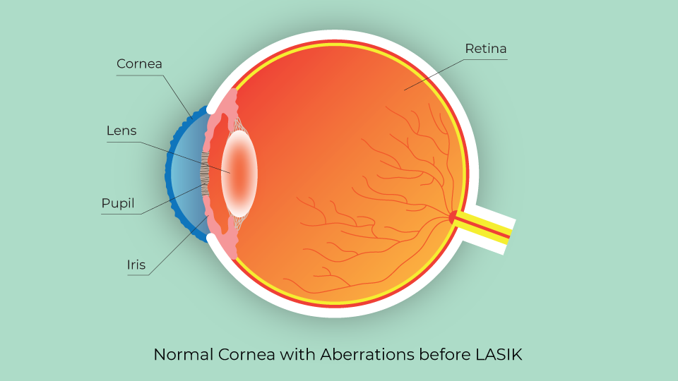Normal cornea with all the inherent imperfections found in all patients' pre-LASIK surgery