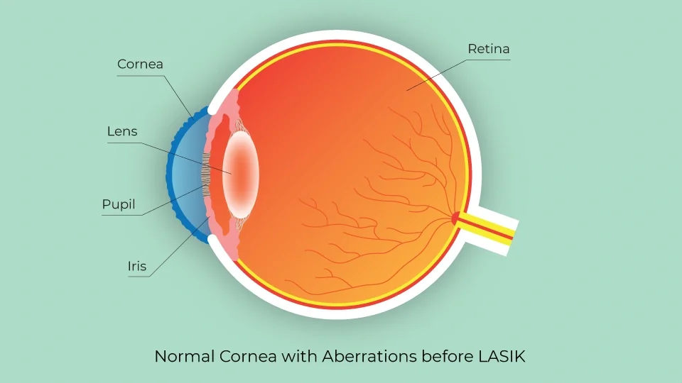 Normal cornea with all the inherent imperfections found in all patients' pre-LASIK surgery