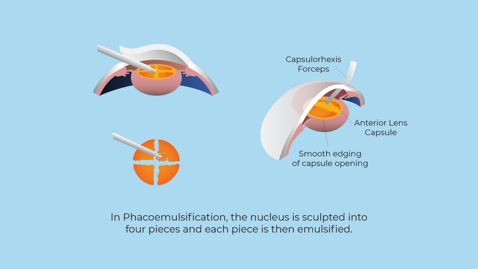Phacoemulsification